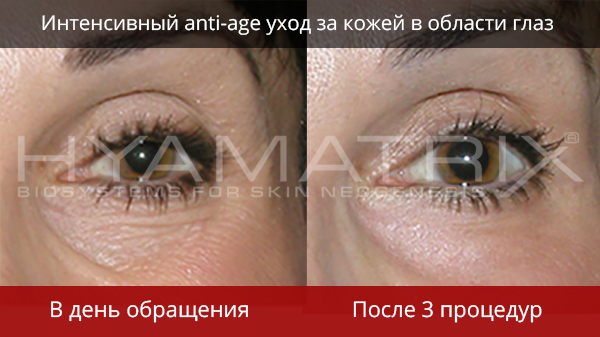 Hyamatrix гель для кожи вокруг глаз